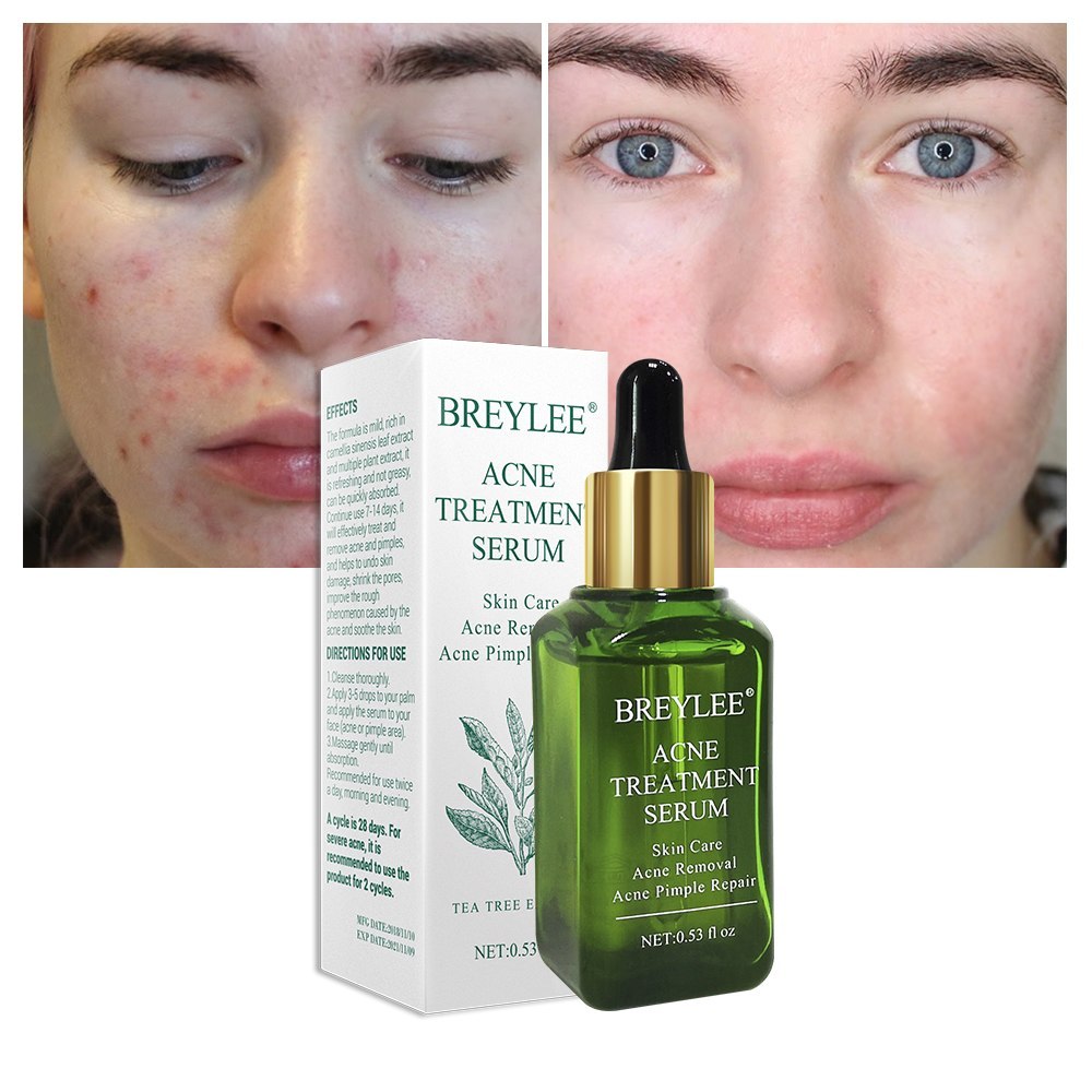 BREYLEE Acne Treatment Serum Face Facial Anti Acne Scar Removal Cream Skin Care Whitening Repair Pimple Remover For Acne BREYLEE Acne Treatment Serum Face Facial Anti Acne Scar Removal Cream Skin Care Whitening Repair Pimple Remover For Acne